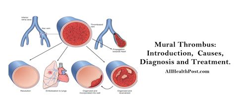 mural thrombus treatment guidelines